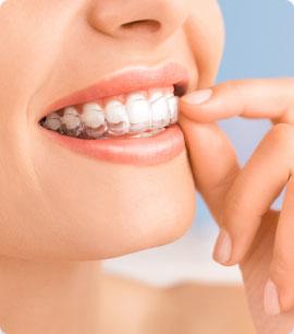 Invisalign Image
